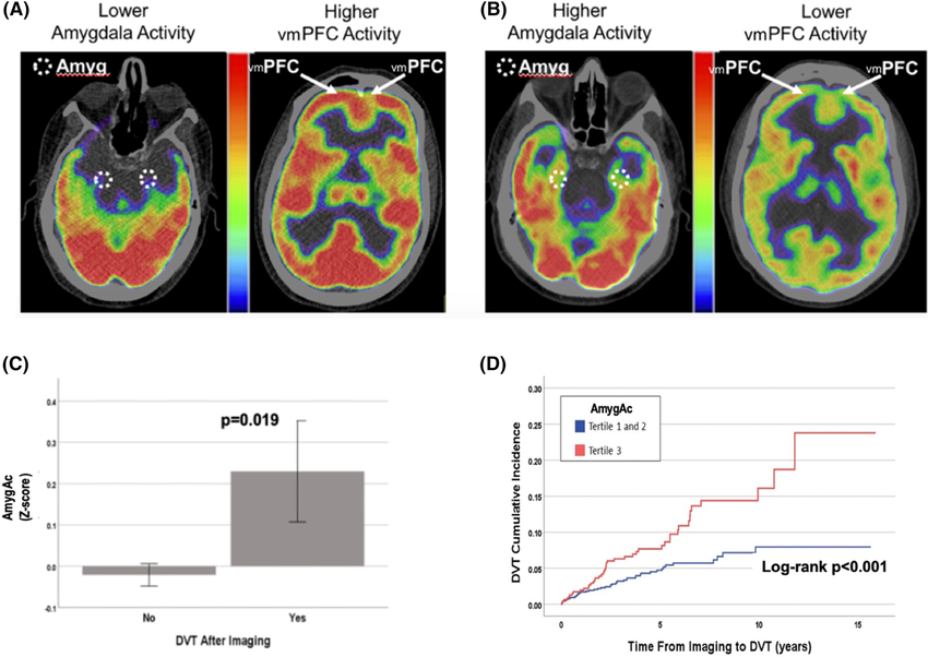 A Example of axial brain F FDG PET images with low SNA B Example of axial brain