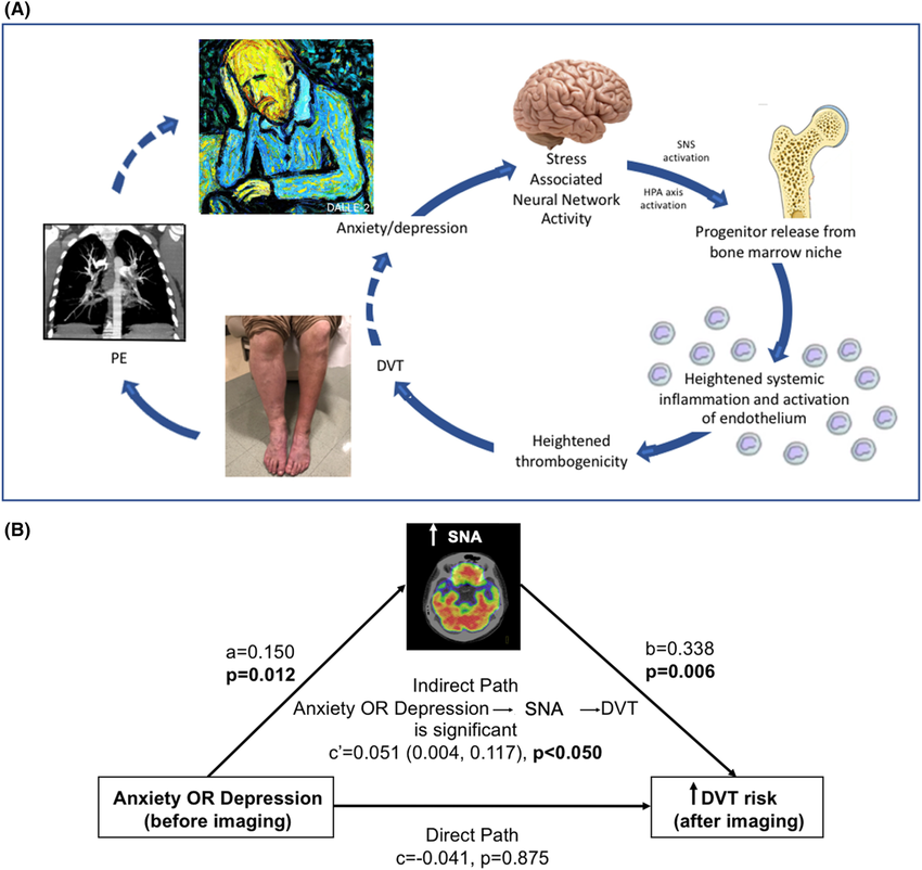 A Hypothesized mechanism linking anxiety and depression to DVT and PE through SNA DVT