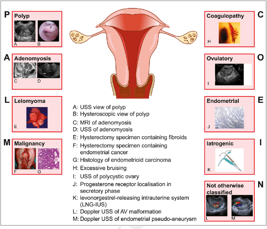 FIGO classification of causes of AUB PALM COEIN