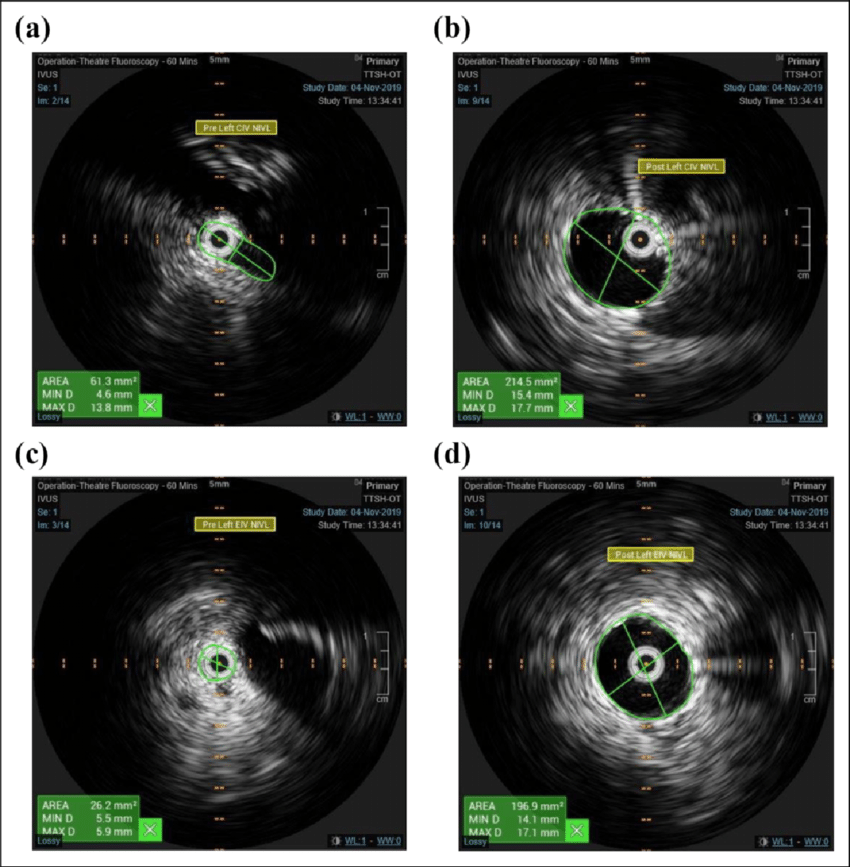 Intravascular ultrasound IVUS of the left common iliac vein a pre stenting and b