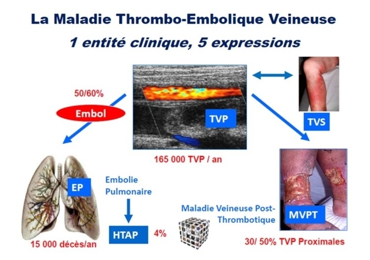 MTEV5