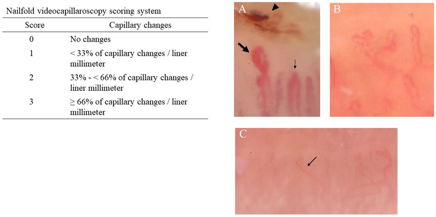 Nailfold videocapillaroscopy scoring system based on Cutolo et al 26 A