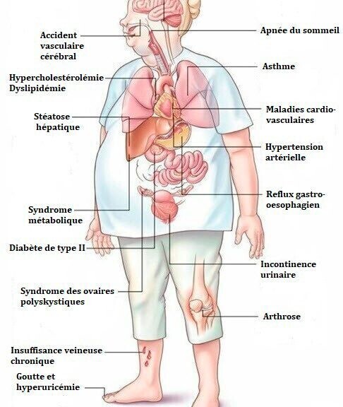 obesite maladies 486x576