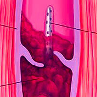 pharmacomechanical catheter directed thrombolysis for deep vein thrombosis