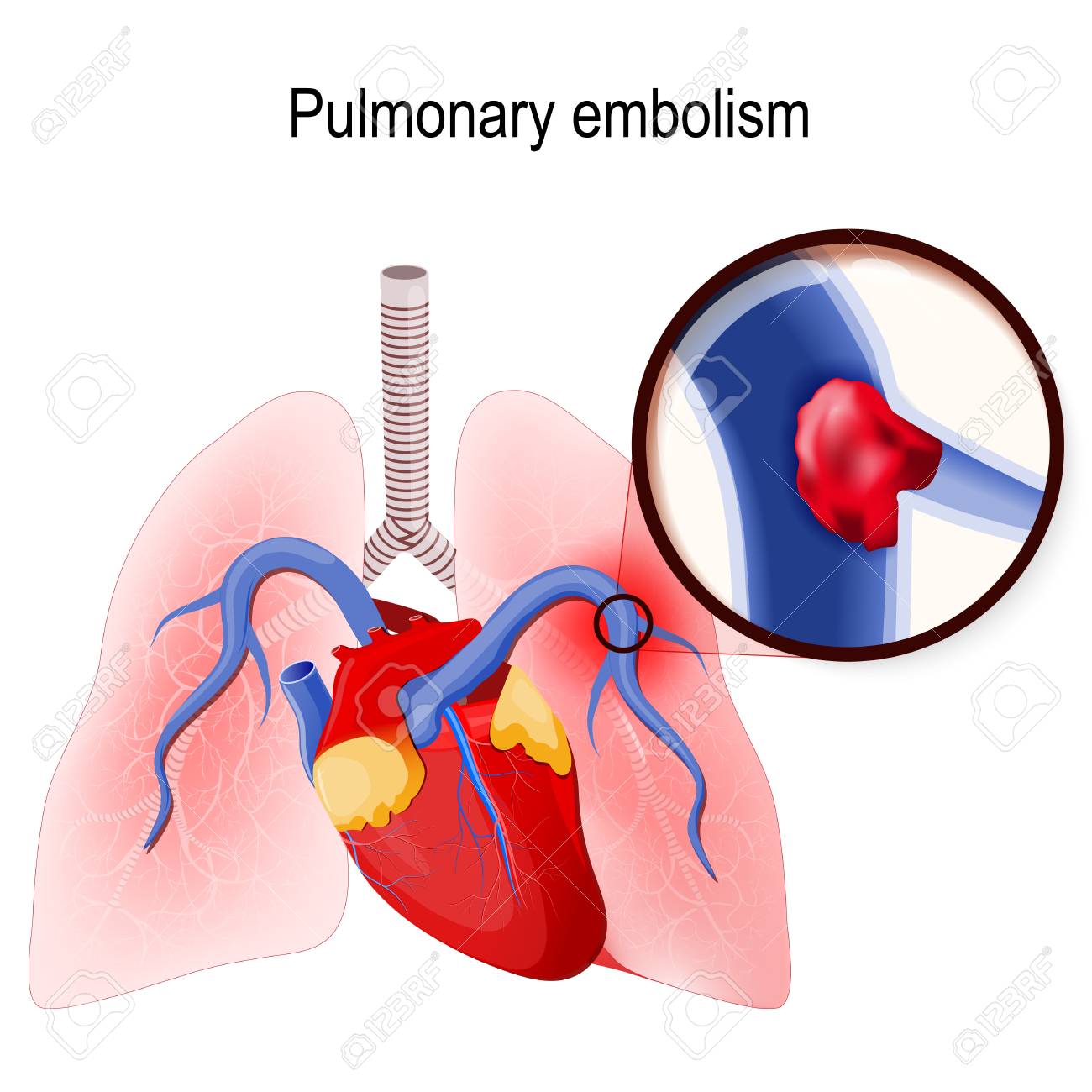 Pulmonary embolism. Blockage of the main artery of the lung or one of its branches by a blood clot that has travelled from elsewhere in the body through the bloodstream. Human lungs and heart. blood clot in the vein (close up)