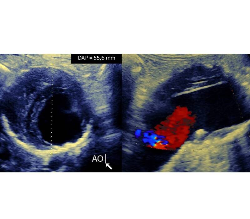 Dépistage des AAA chez les femmes  : back to the futur !