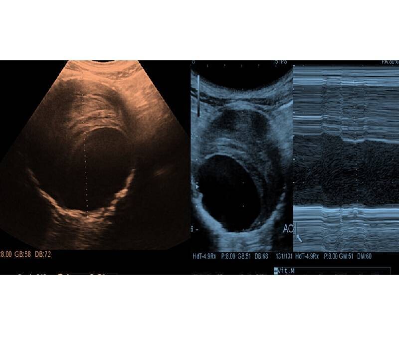 Anévrisme Aorte : imagerie