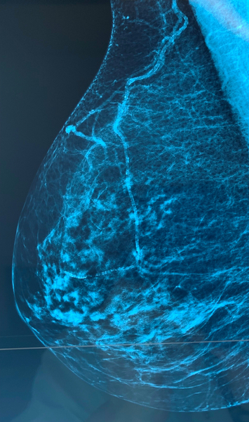 Calcifications arterielles et risque cardio vasculaire 361 1