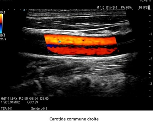 Info Patient  : dissection carotidienne