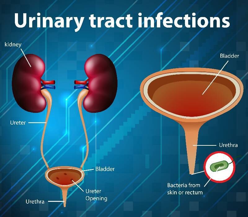 Micro plastiques et voies urinaires