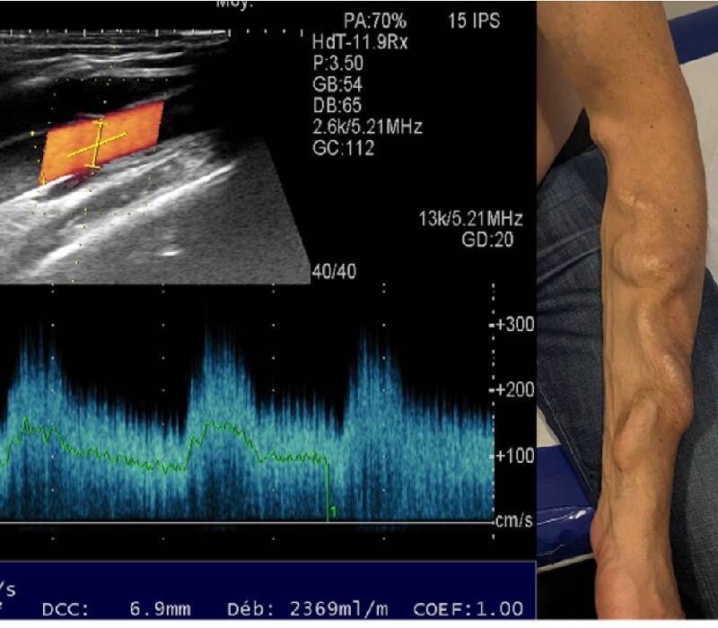 Hémodialyse et anticoagulation : une nouvelle piste