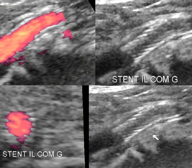 ANTITHROMBOTIQUE /ANGIOPLASTIE non cardiaque