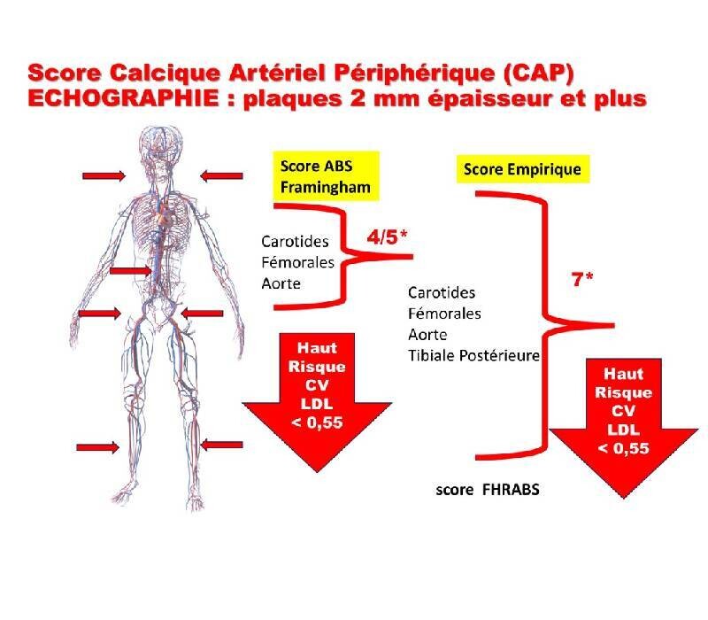 Once upon a times  : score calcique (carotide fémorale)