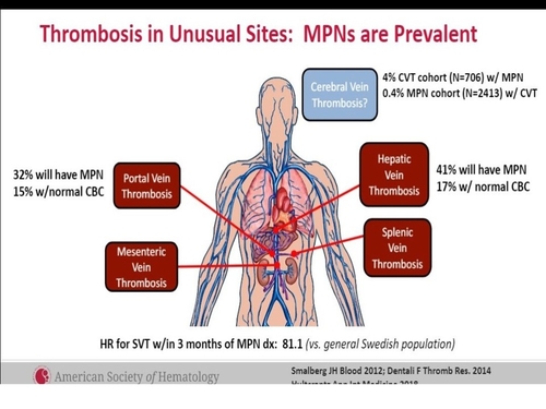 TV Splanchniques et anticoagulation