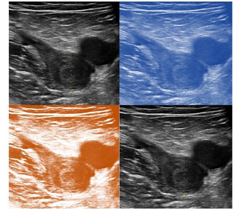 AOD et bilan de thrombophilie
