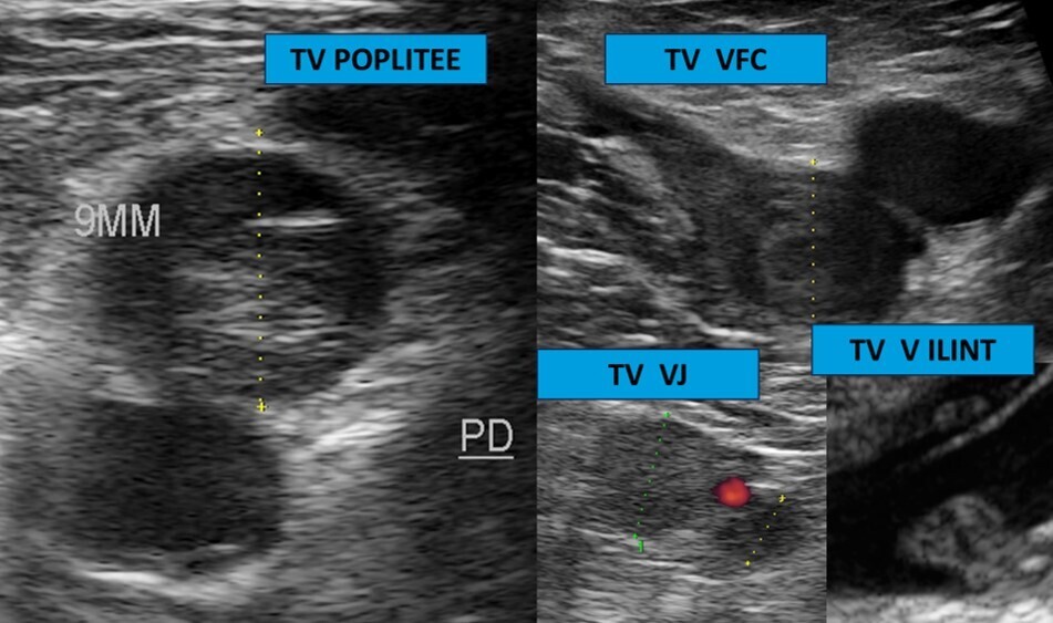 Thromboses veineuses récurrentes  et cancer