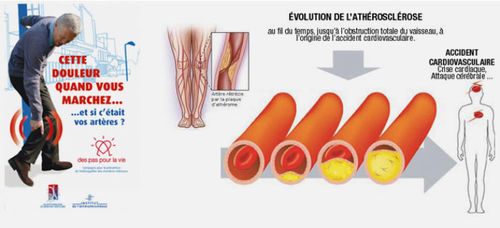  ESC 2021 : ANTITHROMBOTIQUES