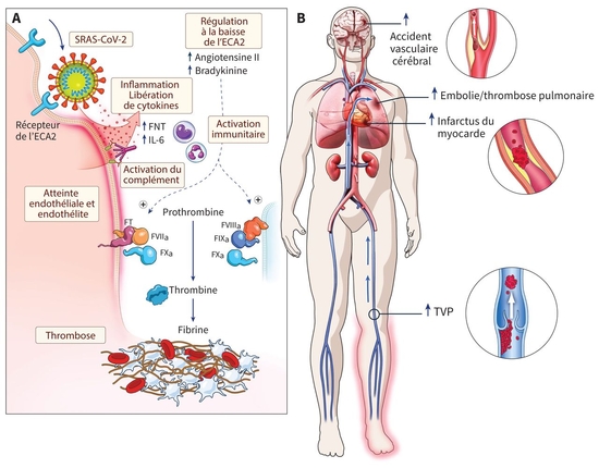 Covid-19 : complications thrombotiques artérielles et veineuses