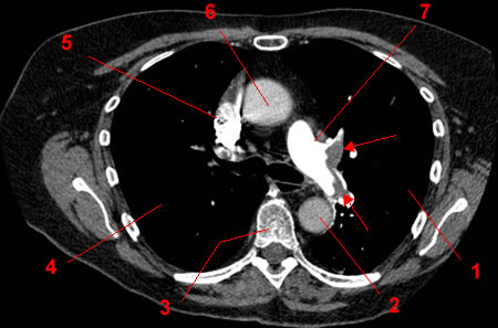 embolie pulmonaire 4b.0001 fs