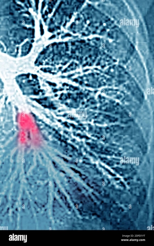embolie pulmonaire dans le lobe inferieur gauche artere pulmonaire bloquee par un caillot de sang angiographie thoracique 2dfd1yt