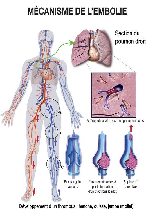 Pulmonary embolism(2).