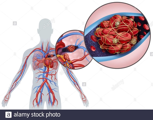 embolisme pulmonaire avec un caillot de sang comme maladie avec un blocage d une artere dans les poumons avec des elements d illustration tridimensionnelle 2b17kdd