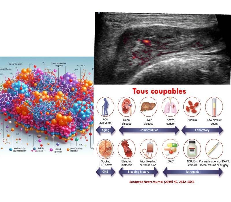 Riete Express : LDL/ MTEV / Risque hémorragique