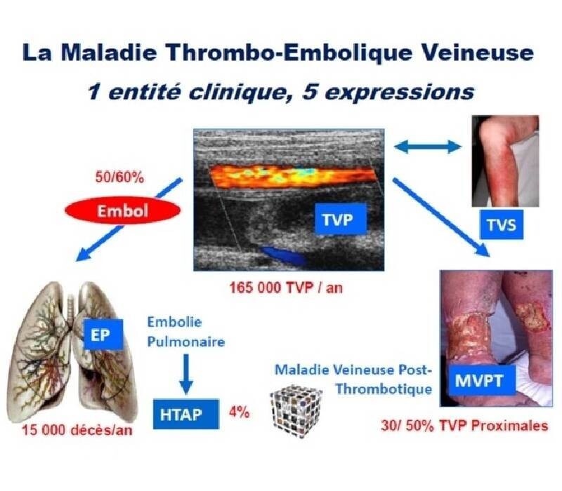 MTEV : complications tardives