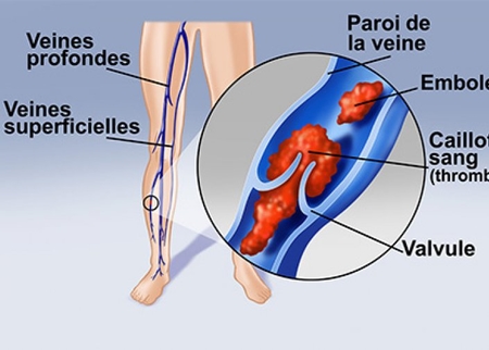 phlebite