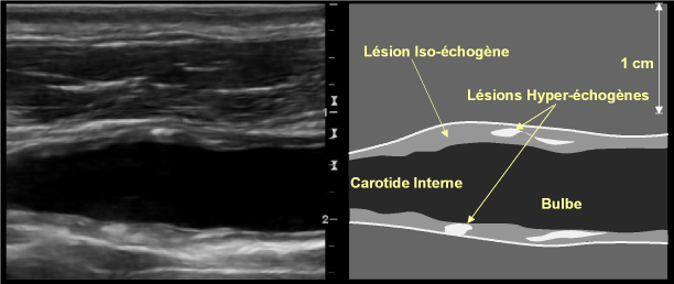pmv us fig 52 séméiologie echographique des plaques a01