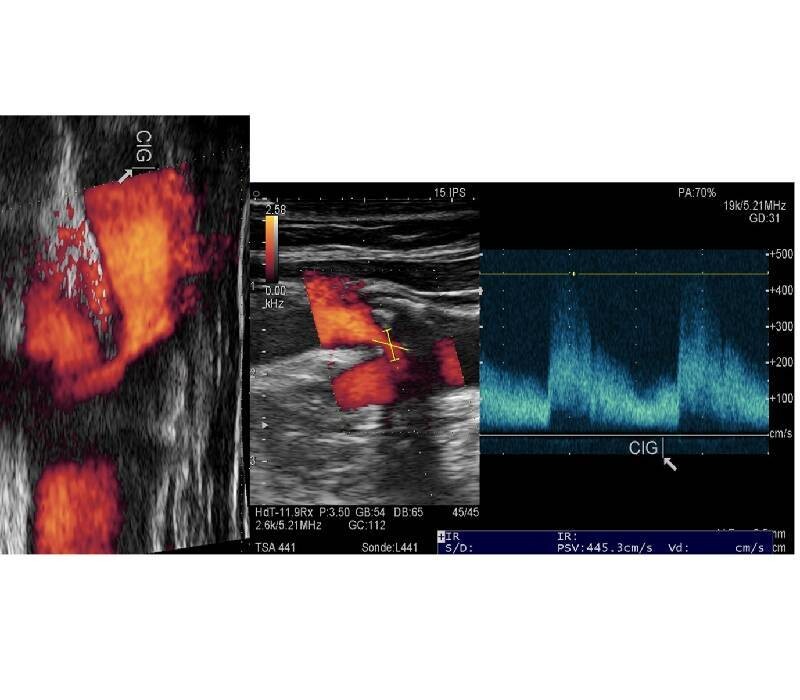 IA : détections plaques carotidiennes symptomatiques