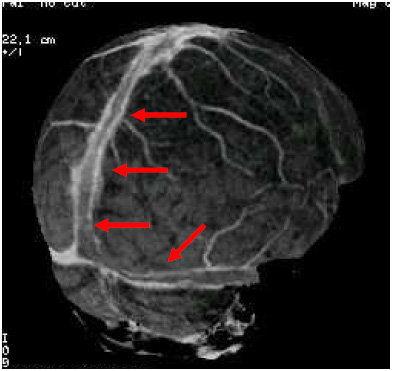 Thrombose Veineuse cérébrale : quel anticoagulant ? 